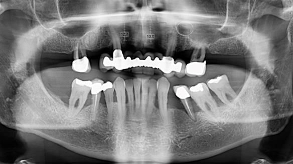 Newsletter 77: Jeremy’s case – immediate complete upper denture