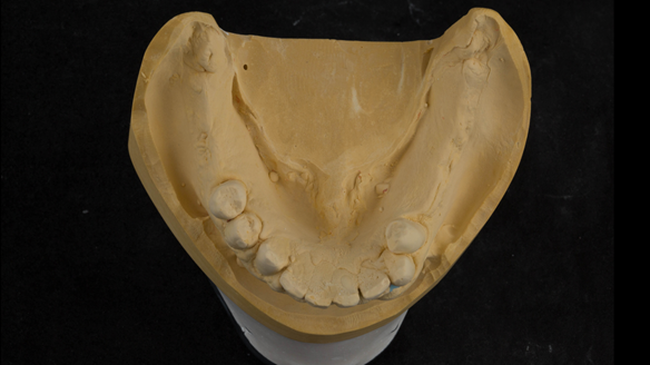 Figure 33 Unprepared definitive cast for lower Mk 1 denture