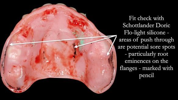 Newsletter 52 Managing Jo’s failing dentition with extractions and Mk 1/Mk 2 complete upper dentures and lower partial dentures FULL PROTOCOL