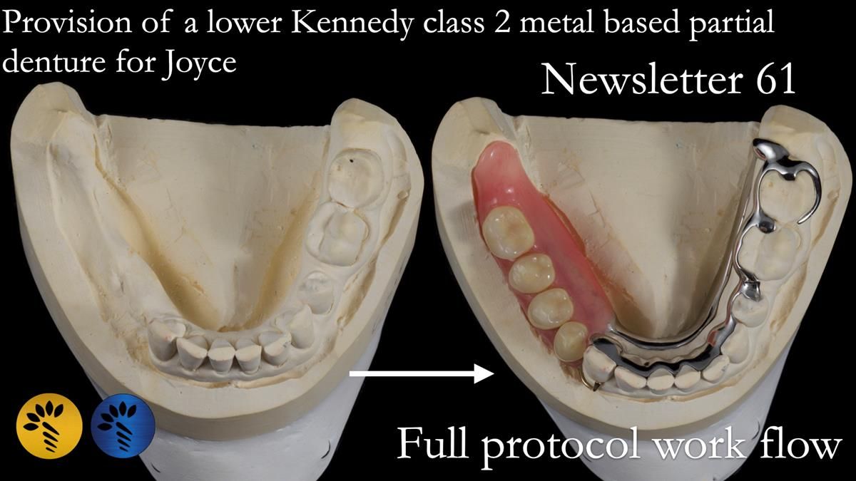 Finlay's Newsletter 61 provision of a lower unilateral free end saddle metal based partial denture for Joyce