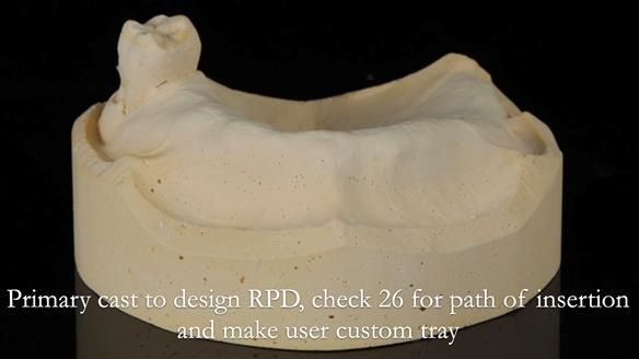 Finlay's Newsletter 58 Gasket upper partial denture for Zoe