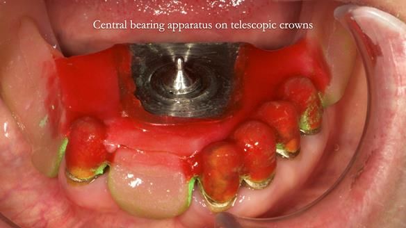Newsletter 76: Jackie’s case – Telescopic overdenture & precision RPD (the tricky truth!)