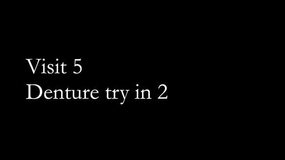 Newsletter 80 - Gordon’s dentures: the one case in 1,000 where my technique failed