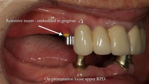 Newsletter 76: Jackie’s case – Telescopic overdenture & precision RPD (the tricky truth!)