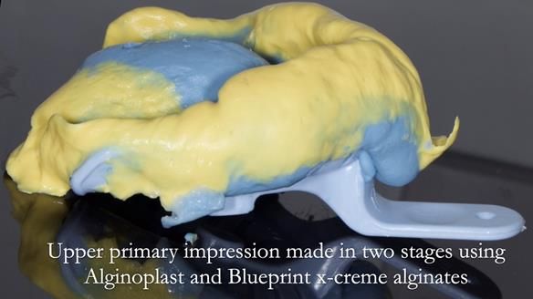 Newsletter 54 case presentation upper complete denture and lower Scandinavian designed hygienic partial denture for David