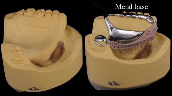 Upper metal base partial denture/occlusal stabilisation splint/obturator - full protocol