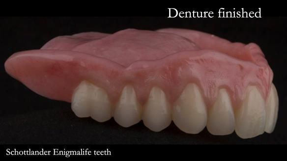 Newsletter 75: Marion’s case - Step-by-step complete denture workflow