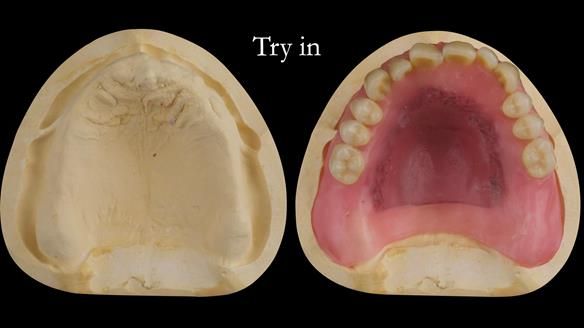 Complete denture Class II div 2 deep overbite Newsletter 39