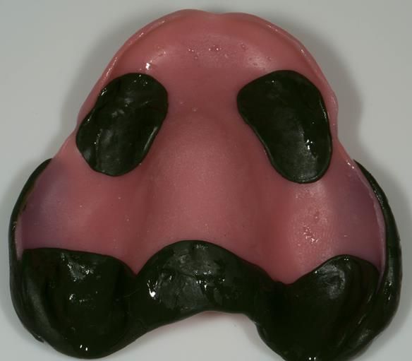Figure 76 Maxillary special tray border moulded with greenstick compound, ensuring a peripheral seal is obtained.