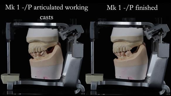Newsletter 54 case presentation upper complete denture and lower Scandinavian designed hygienic partial denture for David