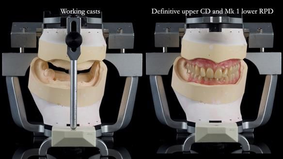 Newsletter 82 Mary - A complete upper and a one-tooth gasket denture