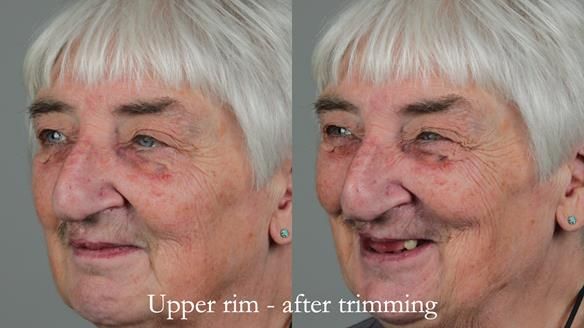 Newsletter 55 Provision of metal based partial dentures for Zephyrine with a repaired cleft lip and palate