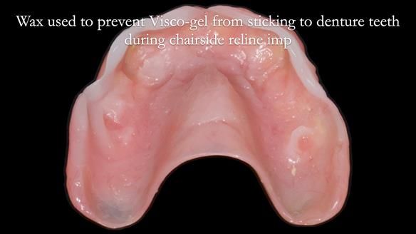 Newsletter 77: Jeremy’s case – immediate complete upper denture