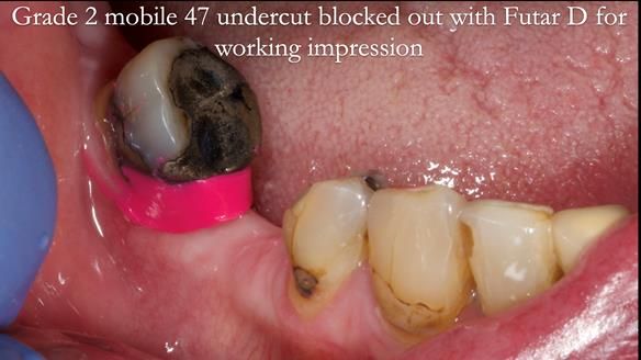 Newsletter 55 Provision of metal based partial dentures for Zephyrine with a repaired cleft lip and palate