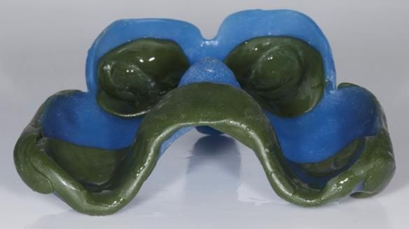 Newsletter 77: Jeremy’s case – immediate complete upper denture