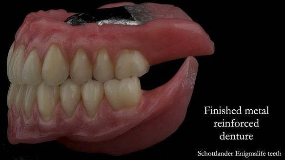 Finished dentures - mimicking Mary’s daughters natural teeth
