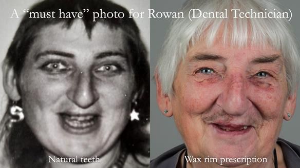 Newsletter 55 Provision of metal based partial dentures for Zephyrine with a repaired cleft lip and palate
