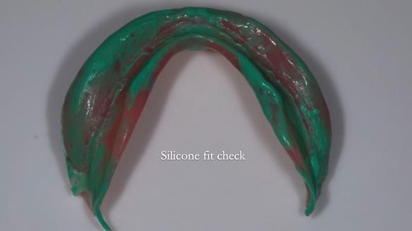 Newsletter 83: Sheila’s Complete Denture Success