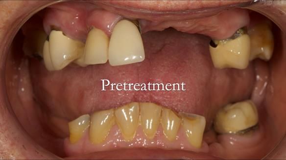 Eileen's transformation with upper and lower RPDs of Scandinavian hygienic design FULL PROTOCOL