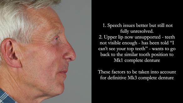 Newsletter 77: Jeremy’s case – immediate complete upper denture