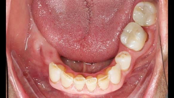 Finlay's Newsletter 61 provision of a lower unilateral free end saddle metal based partial denture for Joyce