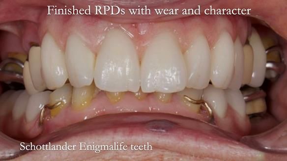 Eileen's transformation with upper and lower RPDs of Scandinavian hygienic design FULL PROTOCOL
