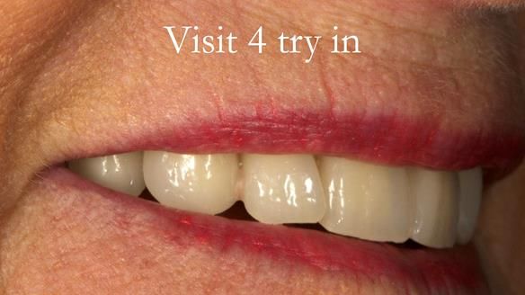 Visit 4 - The patient assesses the try in