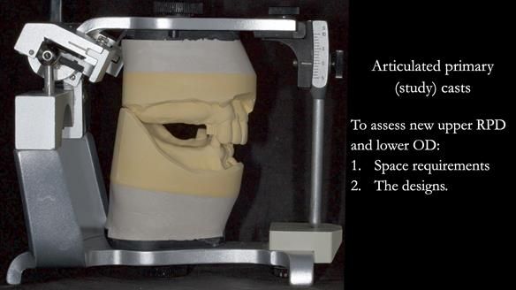 Newsletter 76: Jackie’s case – Telescopic overdenture & precision RPD (the tricky truth!)