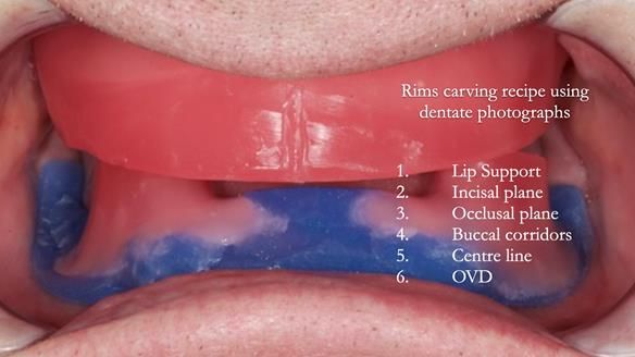 Newsletter 57 showcases the making and fitting process of implant-supported complete dentures for Alisdair
