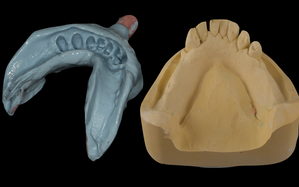 Figure 74 Mandibular definitive impression made in alginate