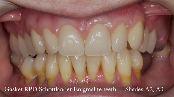 Finlay's Newsletter 58 Gasket upper partial denture for Zoe