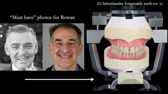 Newsletter 78: What do Clark Gable and a Locator® overdenture have in common?