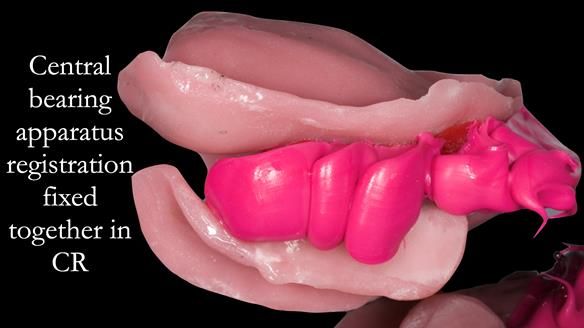 Newsletter 52 Managing Jo’s failing dentition with extractions and Mk 1/Mk 2 complete upper dentures and lower partial dentures FULL PROTOCOL