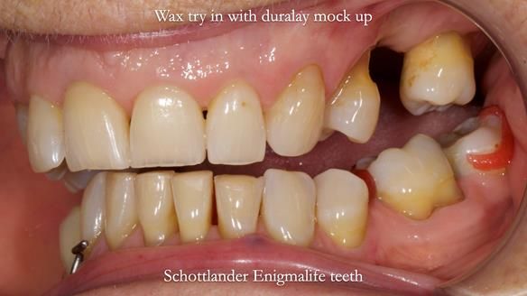 Finlay's Newsletter 61 provision of a lower unilateral free end saddle metal based partial denture for Joyce