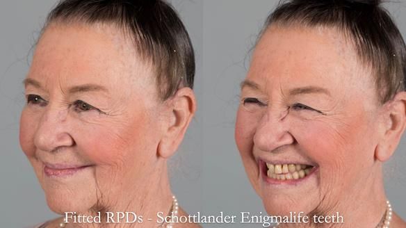 Finlay's Case Study Newsletter 40 - Immediate Mk 1 RPD to Definitive Mk 2 RPD - full protocol