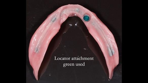 Managing poor implant positioning with complete dentures and Locator attachments - full protocol Newsletter 41