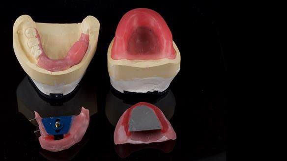 Newsletter 82 Mary - A complete upper and a one-tooth gasket denture