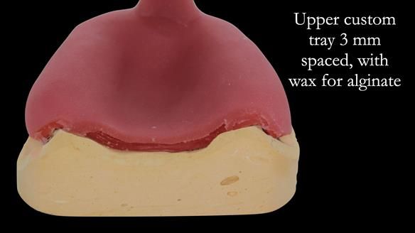 Complete denture Class II div 2 deep overbite Newsletter 39
