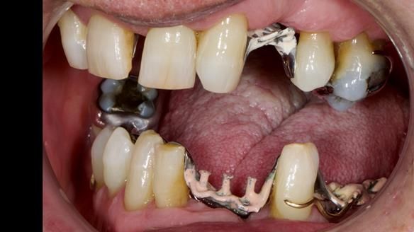 Newsletter 86 Peter the Architect — precision removable partial dentures case study