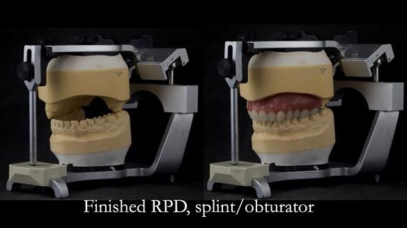 Upper metal base partial denture/occlusal stabilisation splint/obturator - full protocol