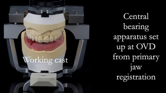 Newsletter 44 - extreme removable prosthodontics – engineering a super-strong and ultra-thin over denture