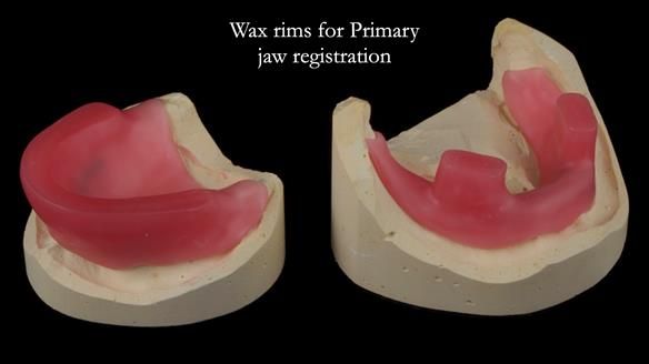 Newsletter 57 showcases the making and fitting process of implant-supported complete dentures for Alisdair