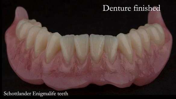 Newsletter 75: Marion’s case - Step-by-step complete denture workflow