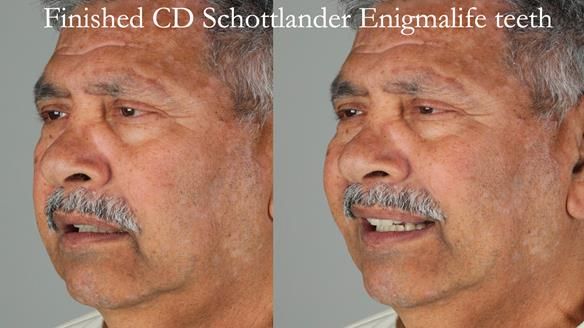 Finlay's Newsletter 62 provision of extractions and metal based complete dentures for Rafique