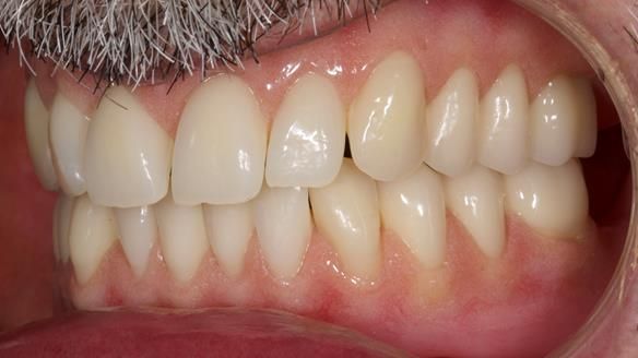 Newsletter 78: What do Clark Gable and a Locator® overdenture have in common?