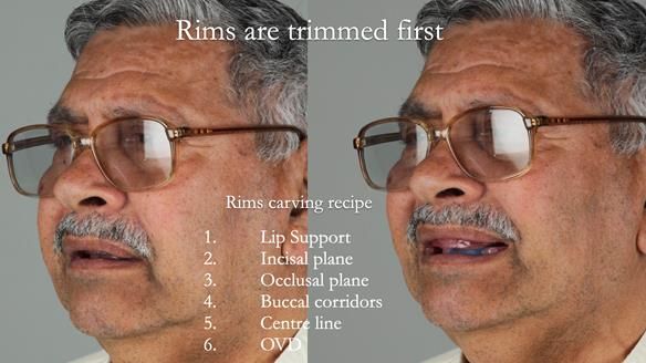 Finlay's Newsletter 62 provision of extractions and metal based complete dentures for Rafique