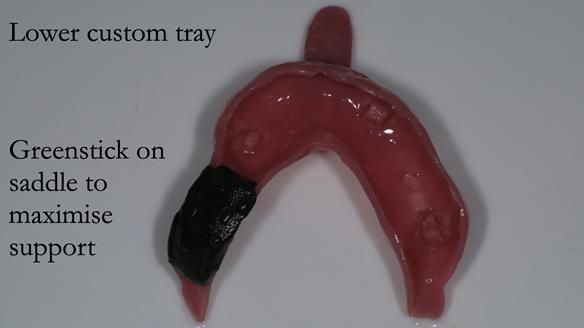 Newsletter 54 case presentation upper complete denture and lower Scandinavian designed hygienic partial denture for David