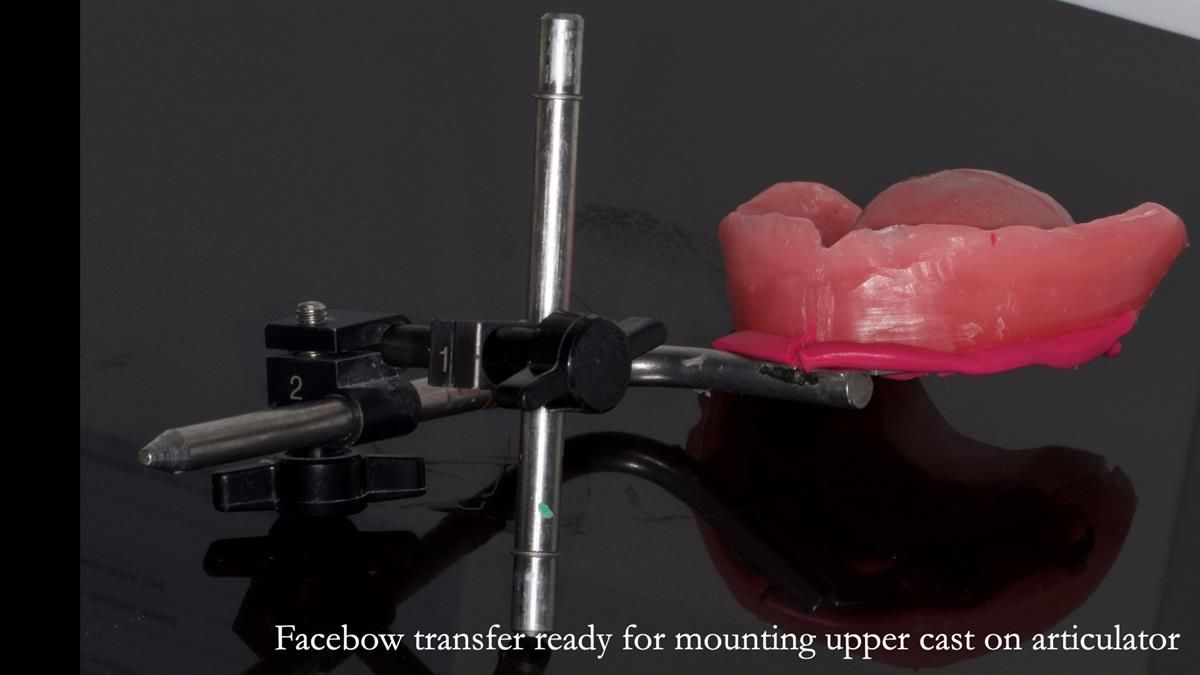 Fin’s Newsletter 88 — Complete dentures - full protocol… he rearranged his own teeth!