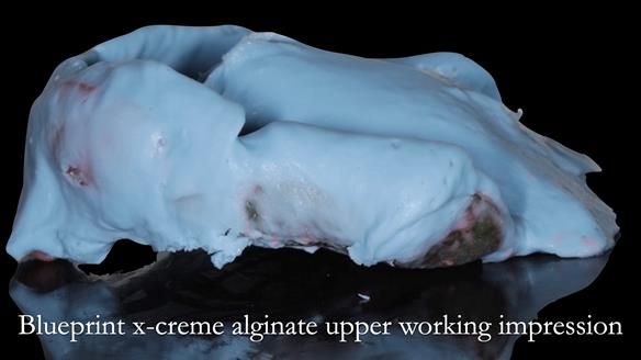 Finlay's Newsletter 62 provision of extractions and metal based complete dentures for Rafique