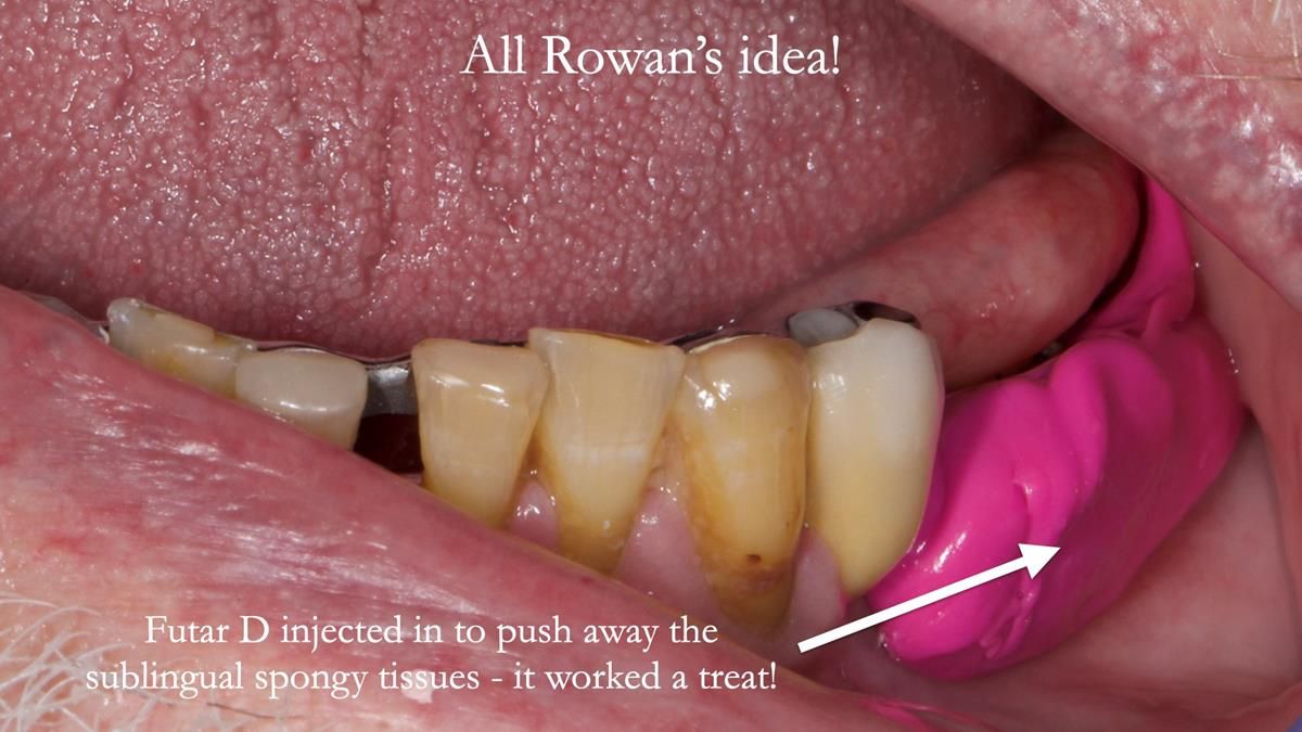 Newsletter 87 – Father Peter: A Partial Denture that needed Minor Miracle